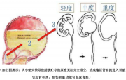 脊髓损伤截瘫引起大小便失禁有哪些手术治疗方法、效果与案例？